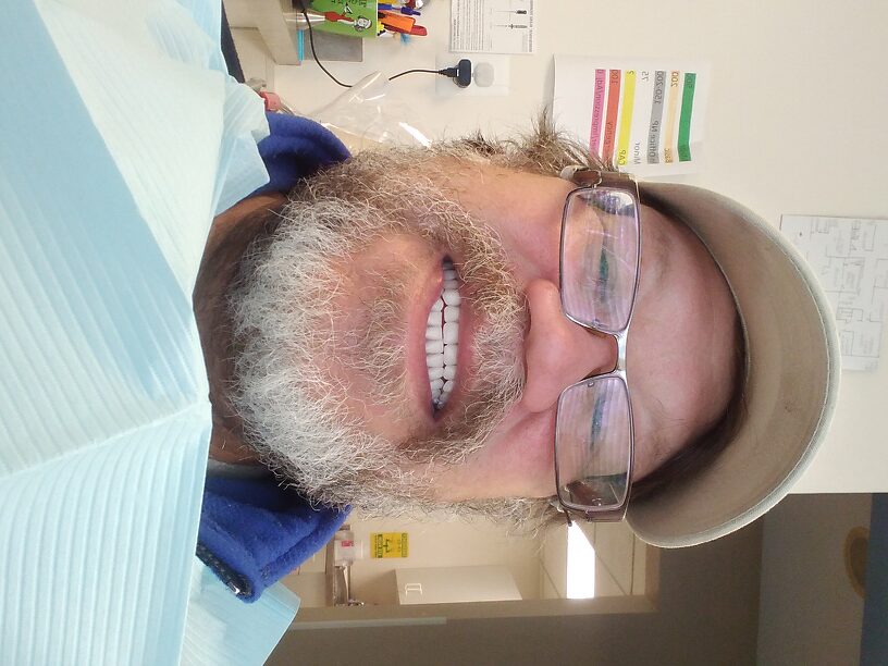 Painkillers are helping! But, these are NOT my teeth (yet?)...they feel FOREIGN